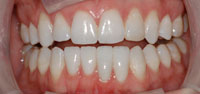 Instant Orthodontics Before